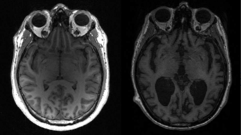 L'efficacité d'un médicament anti-Alzheimer confirmée par les résultats d'une étude clinique