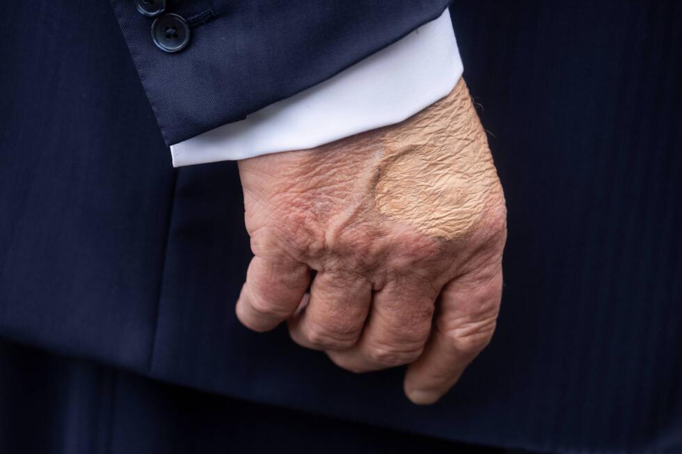 Donald Trump, les jambes enflées, souffre d'insuffisance veineuse