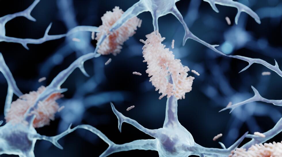 Pourquoi le lithium suscite de nouveaux espoirs face à la maladie d’Alzheimer ? Pourquoi le lithium suscite de nouveaux espoirs face à la maladie d’Alzheimer ?