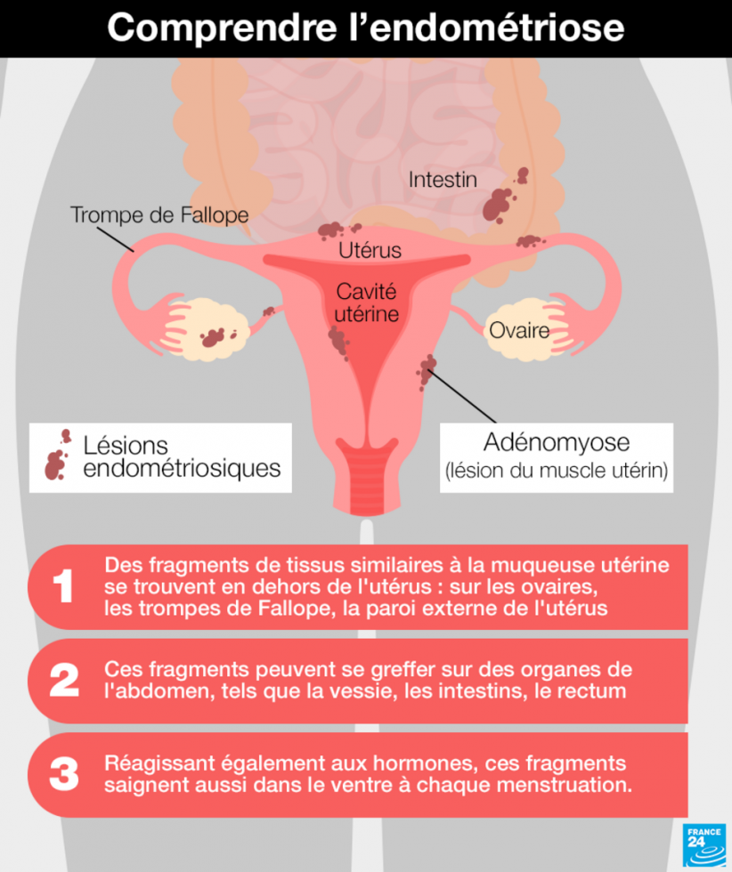 De "fluide impur" à espoir face à l'endométriose : une collecte inédite de sang des règles en France